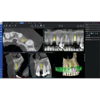 Модуль Romexis 3D Implant