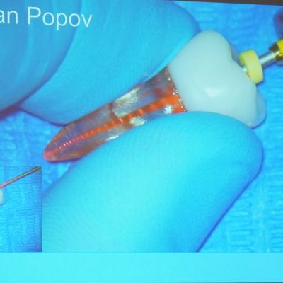 Ендо без компромісів: два підходи, один майстер-клас — вибір стоматолога!