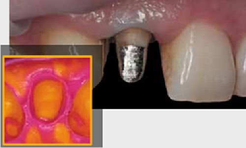 Express XT Regular Body