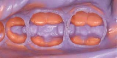 Зняття відбитку під коронку