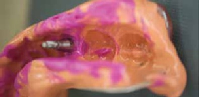 Зняття відбитку під мостоподібний протез